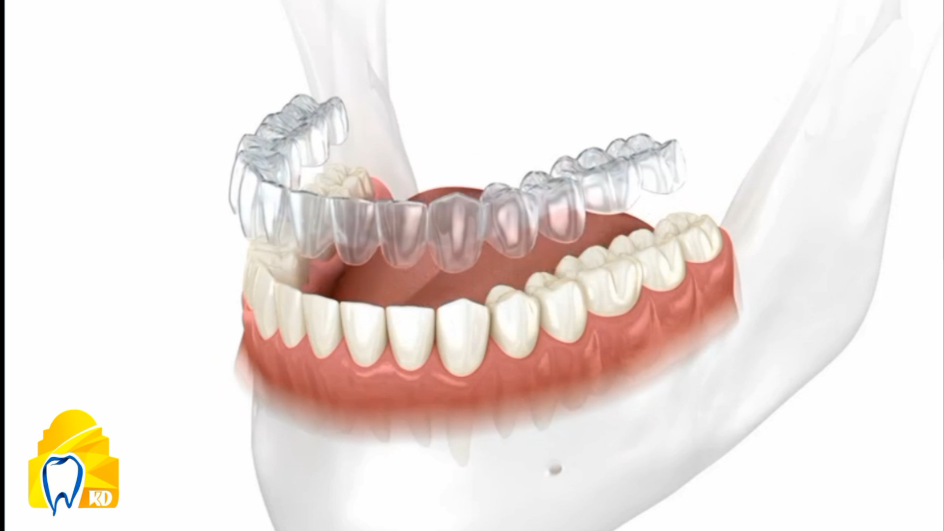 ارتودنسی نامرئی کلینیک دندانپزشکی کارمادنت