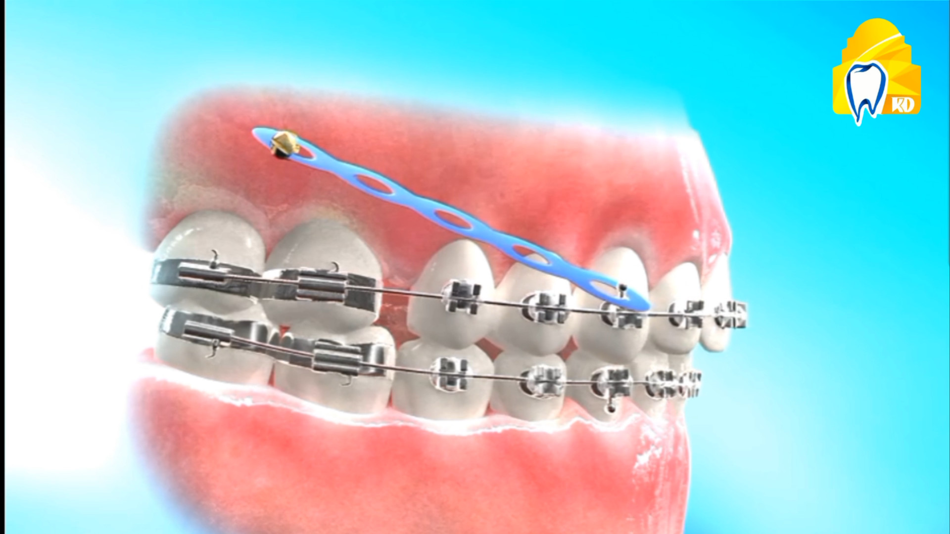 ارتودنسی و استفاده از اسکرو برای اصلاح دندان ها کلینیک دندانپزشکی کارمادنت