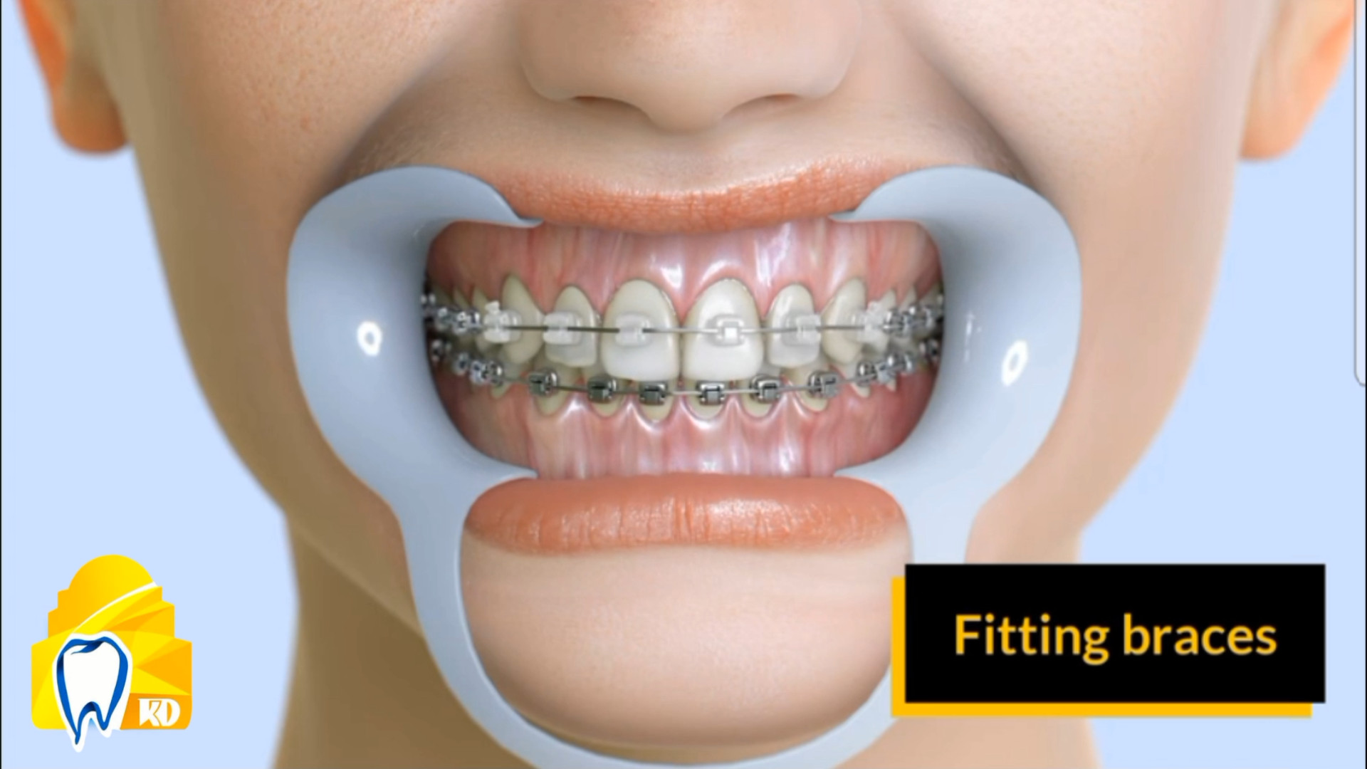ارتودنسی و براکت گذاری کلینیک دندانپزشکی کارمادنت
