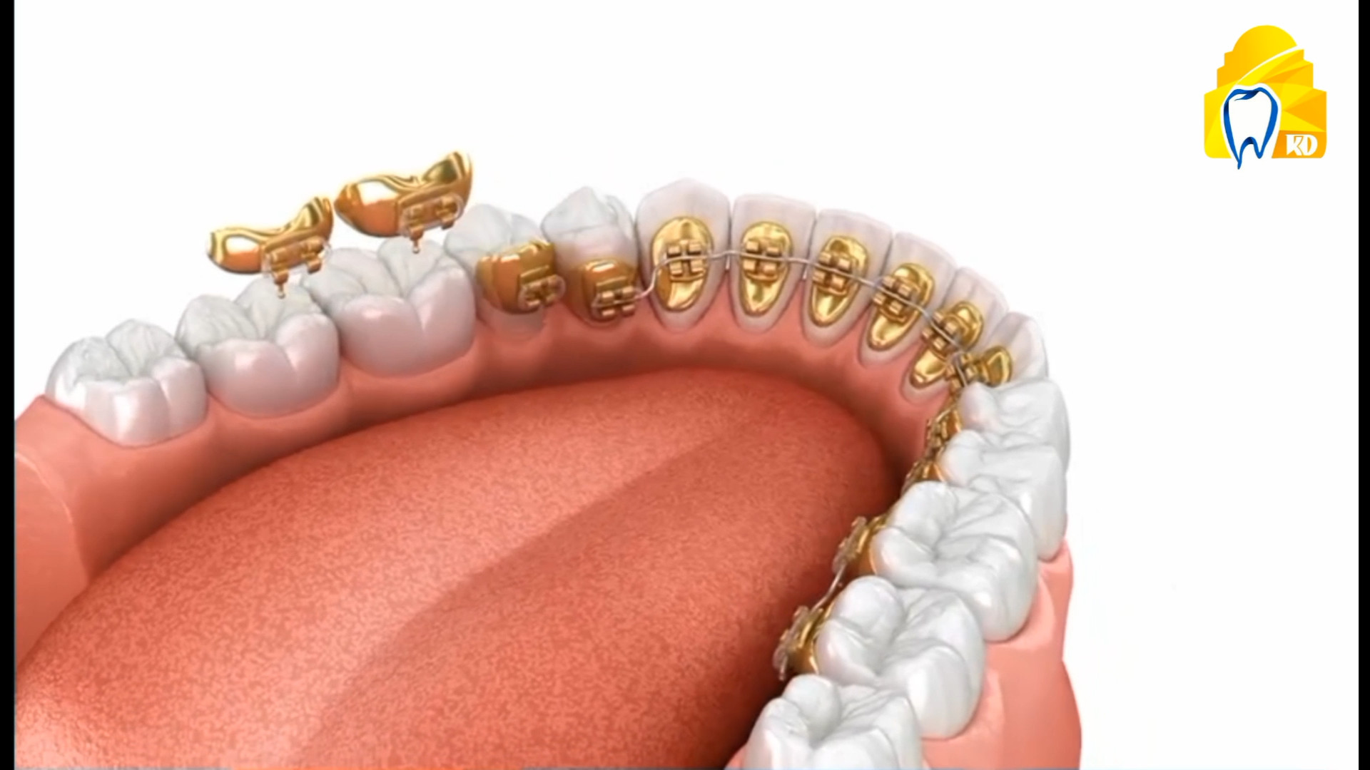 ارتودنسی و براکت لینگوالی کلینیک دندانپزشکی کارمادنت