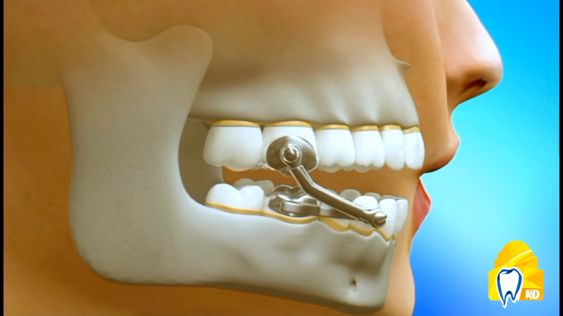 ارتودنسی و بیمار کلاس 2 کلینیک دندانپزشکی کارمادنت