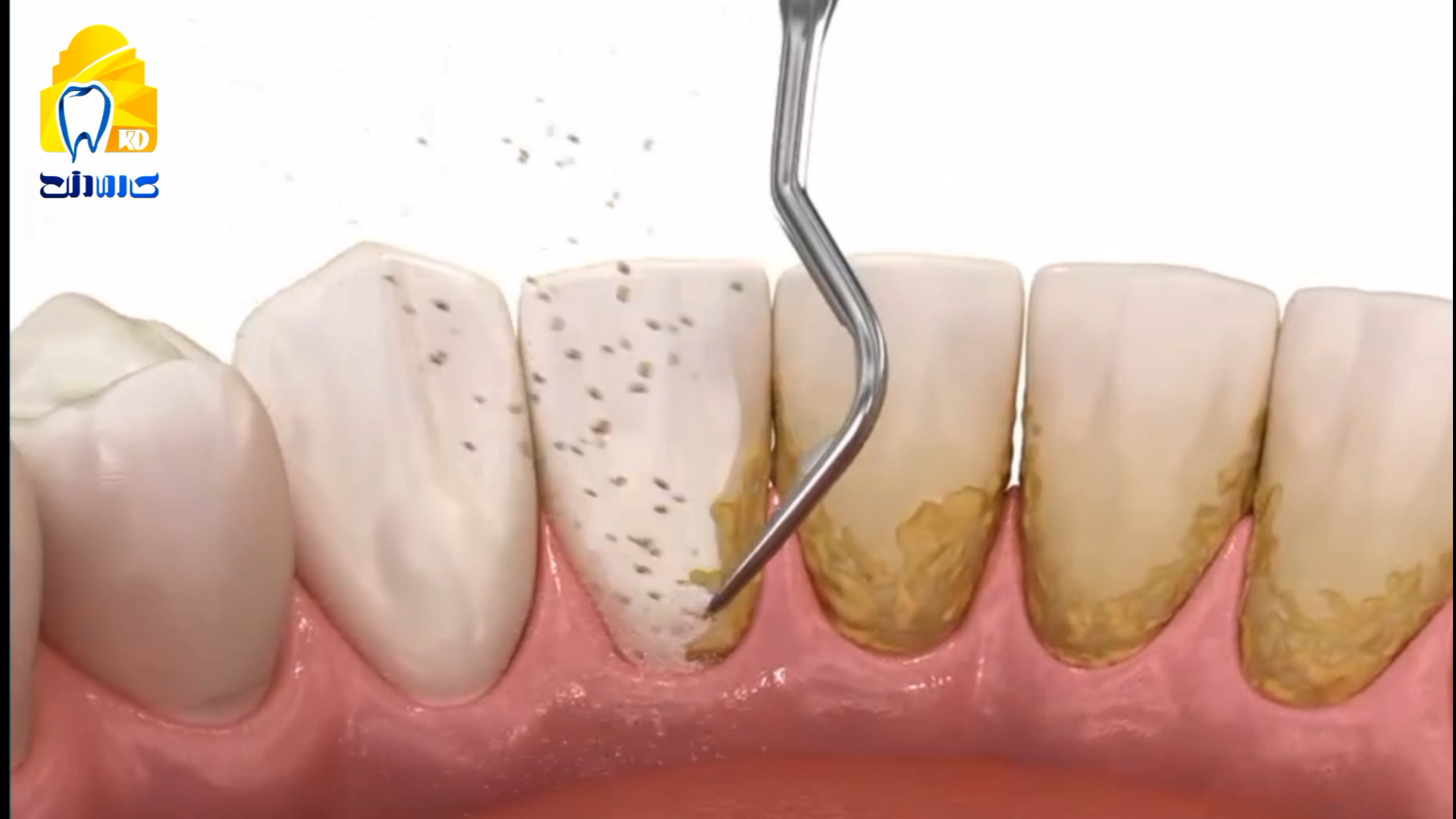 جرمگیری با التراسونیک کلینیک دندانپزشکی کارمادنت