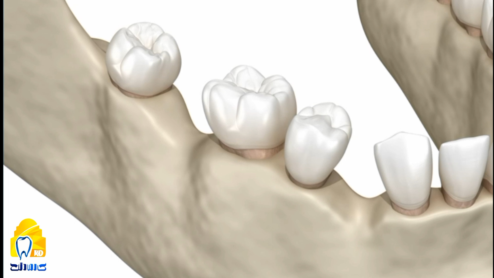 از دست دادن دندان ها و تحلیل استخوان کلینیک دندانپزشکی کارمادنت