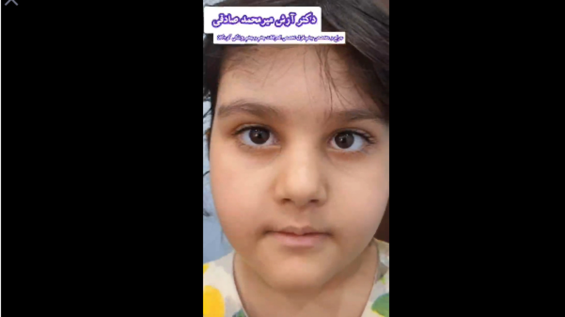 جراحی استرابیسم چشم تست تحریک ACTH