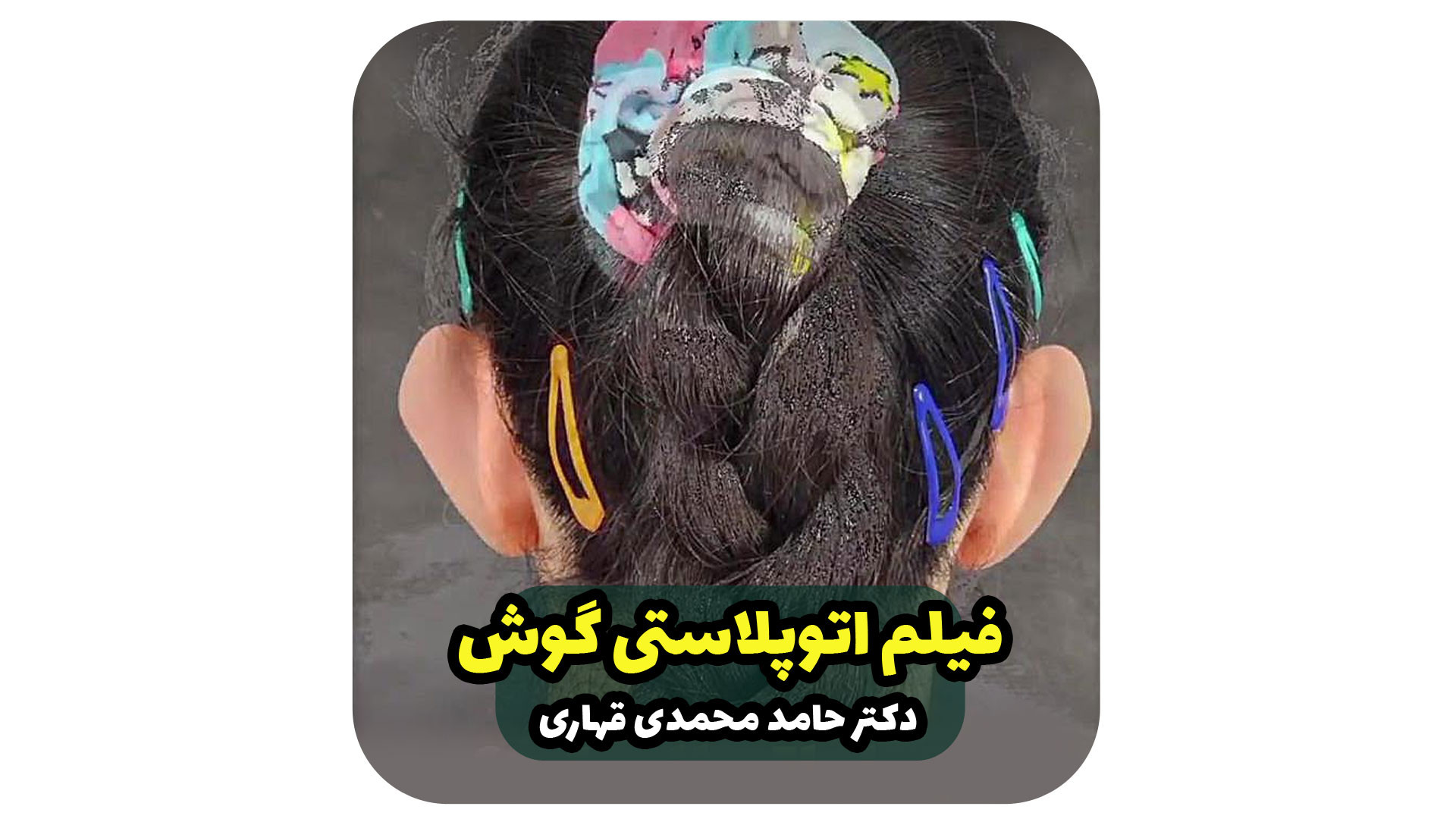 فیلم اتوپلاستی گوش دکتر حامد محمدی قهاری