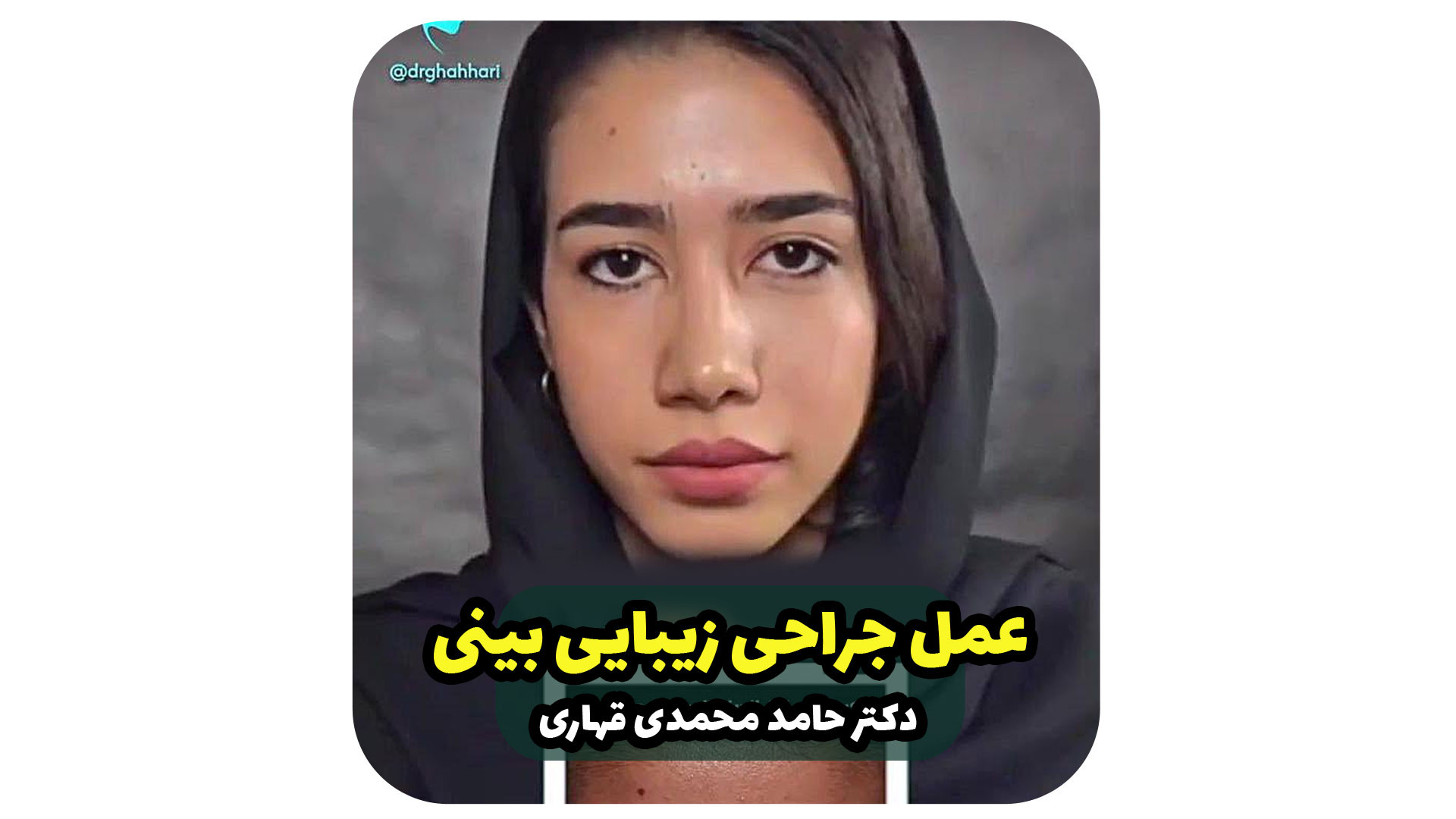 عمل جراحی زیبایی بینی دکتر حامد محمدی قهاری