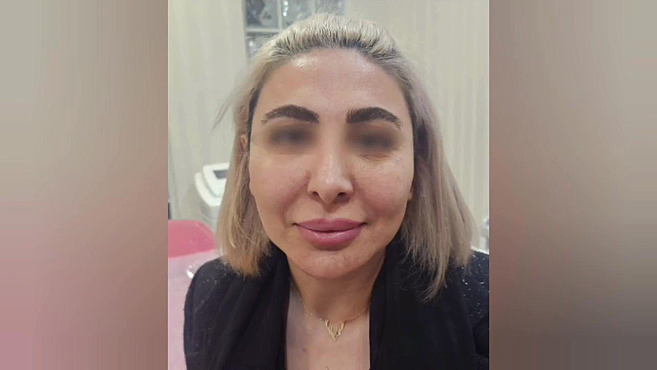 انجام لیفت ابرو با نخ دو سوزنه Metagenomics