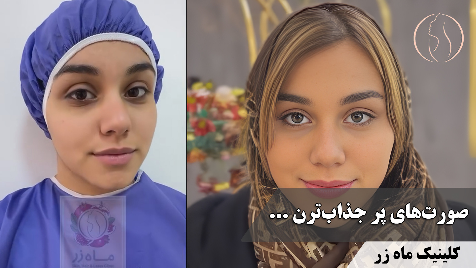 یلدا نزدیکه و وقتی کسی رو می‌بینی ... ( کلینیک زیبایی ماه زر ) بررسی سطح اسید لاکتیک خون