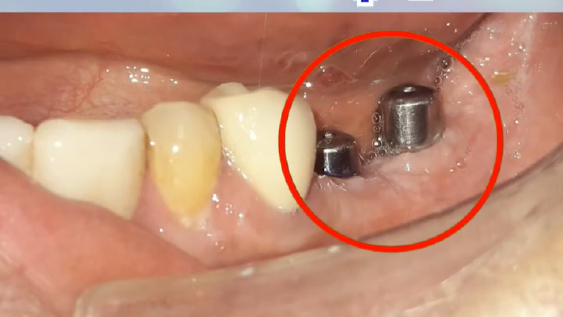 نتیجه ایمپلنت دندان دکتر علی قمری - متخصص جراحی لثه و ایمپلنت
