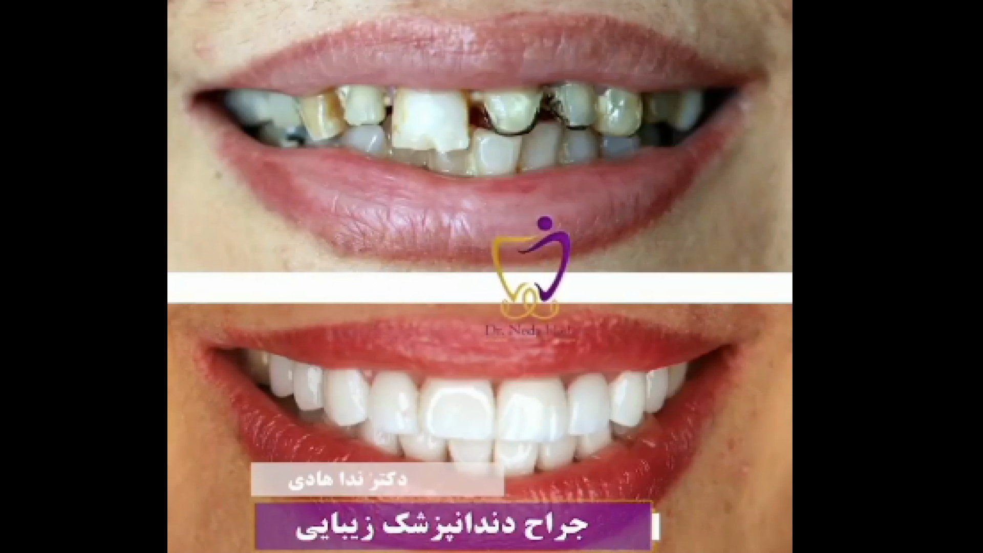 نمونه کار کامپوزیت دندان دکتر ندا هادی-دندانپزشک زیبایی