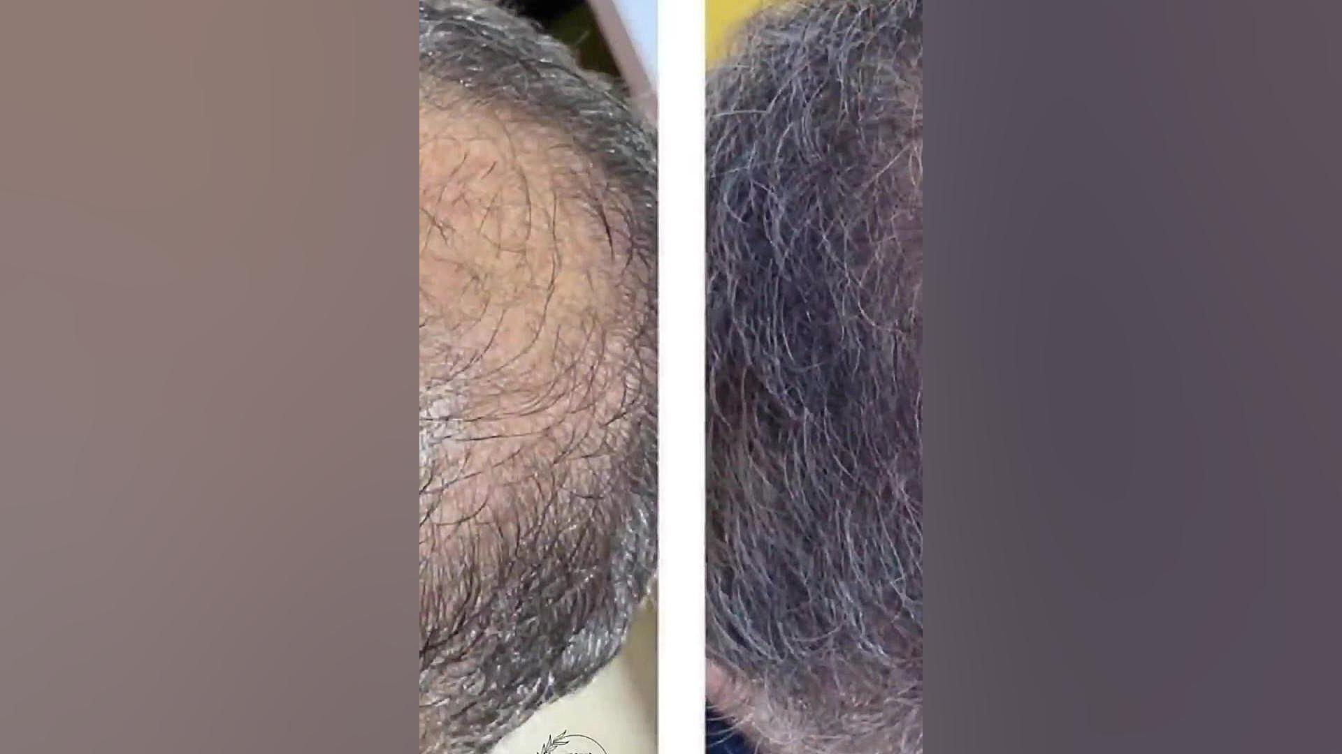 مزوتراپی مو در کلینیک زیبایی رخ عظیمیه کرج پیلینگ