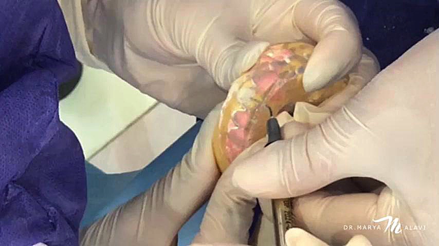 آموزش اینجکشن تکنیک دکتر مریم علوی