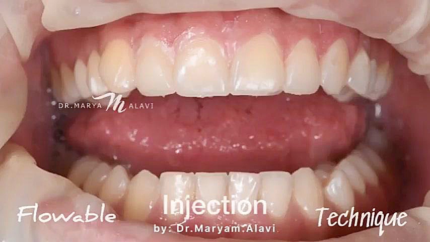 اینجکشن تکنیک دکتر مریم علوی