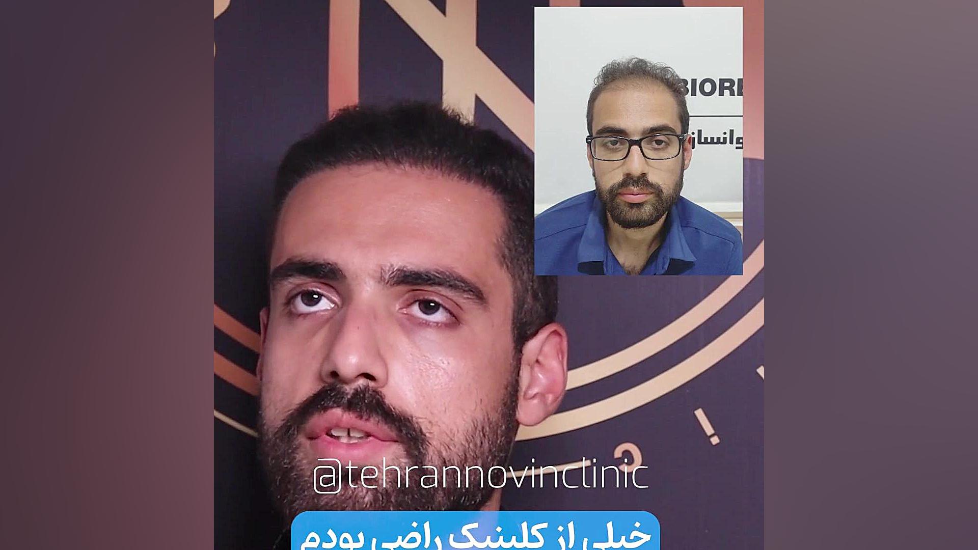 کاشت مو جراحی فک