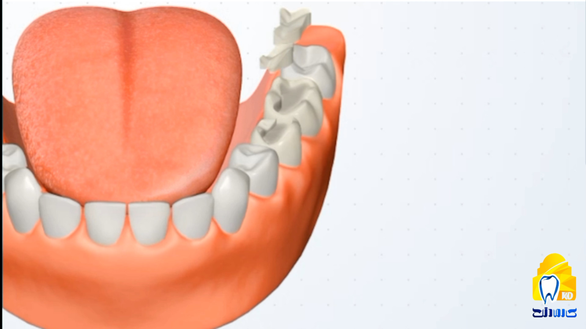 روکش اینله کلینیک دندانپزشکی کارمادنت