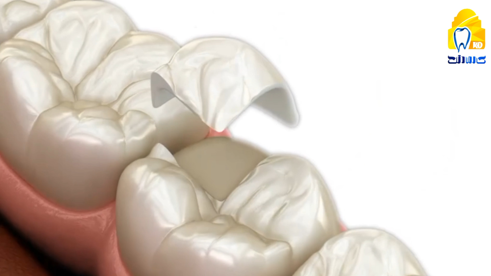 روکش آنله 2 کلینیک دندانپزشکی کارمادنت