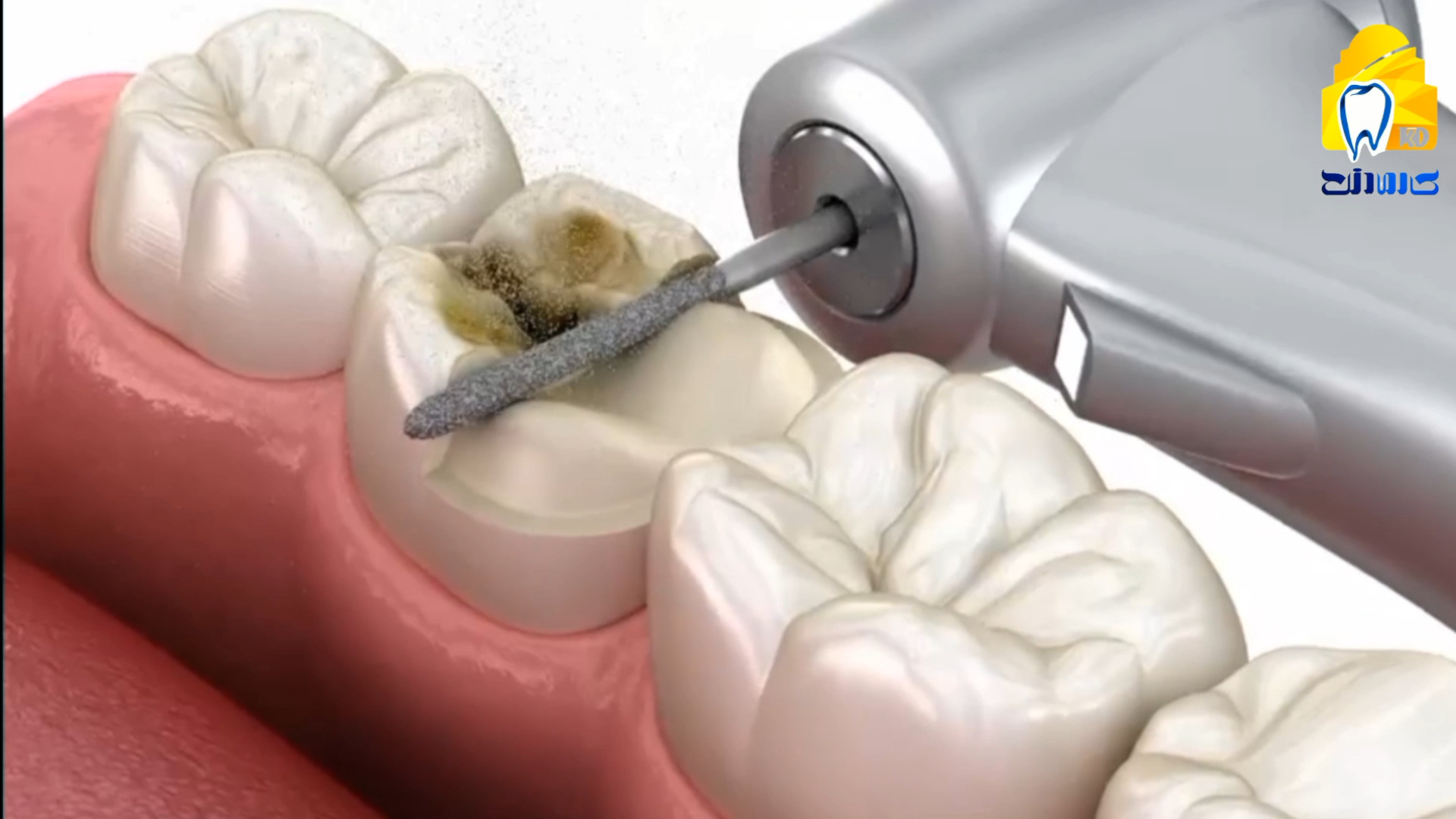 روکش آنله کلینیک دندانپزشکی کارمادنت