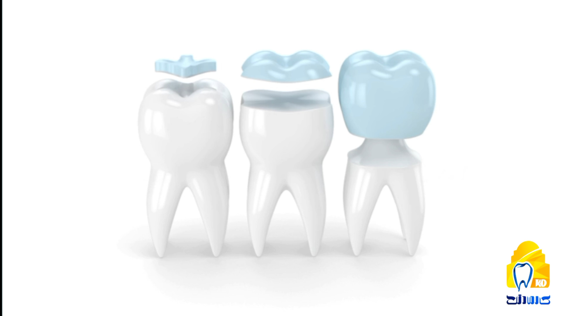 تفاوت اینله، آنله و روکش کامل کلینیک دندانپزشکی کارمادنت