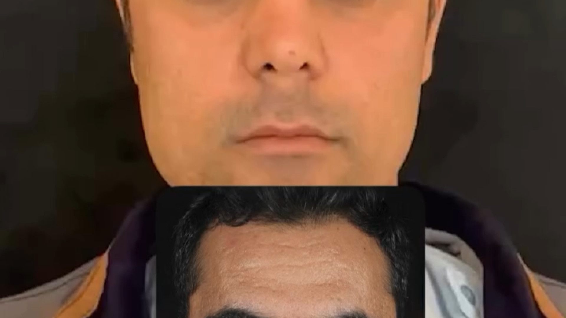 لیفت پیشانی همزمان با جراحی بینی دکتر فرهاد حافظی