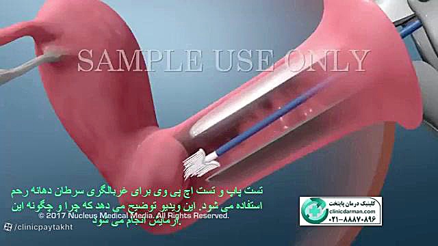 نحوه آزمایش اچ پی وی - کلینیک پایتخت لیپوست