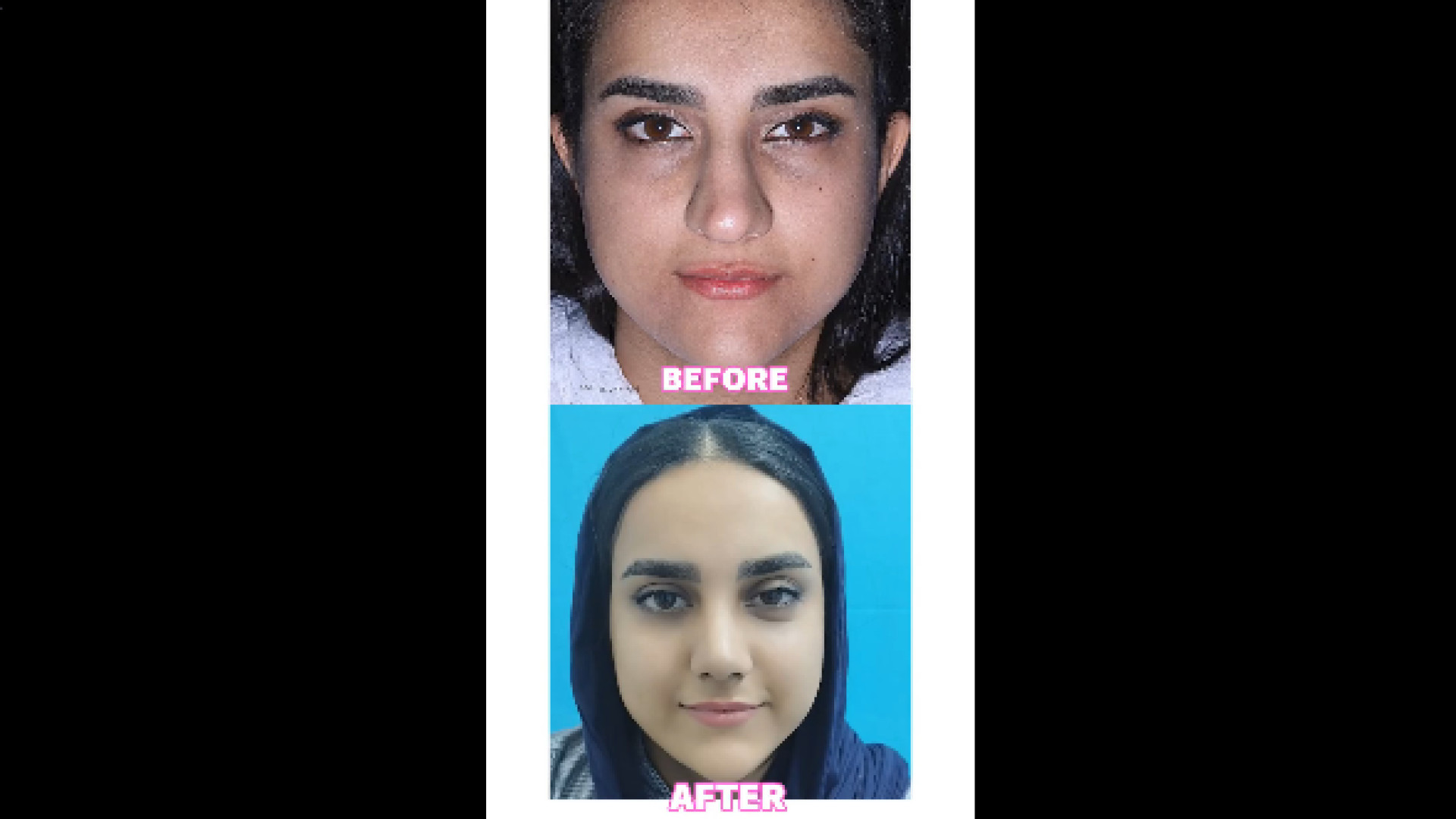 قبل و بعد عمل بینی دکتر علی جمشیدی