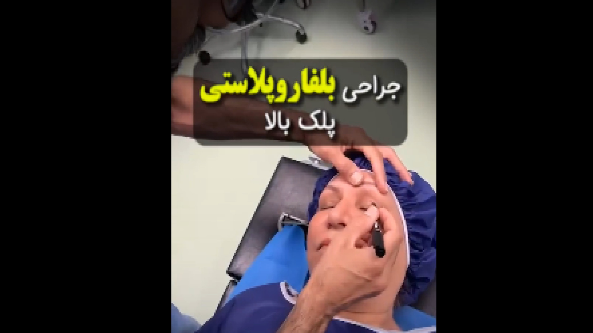 جراحی بلفاروپلاستی پلک بالا دکتر علی جمشیدی