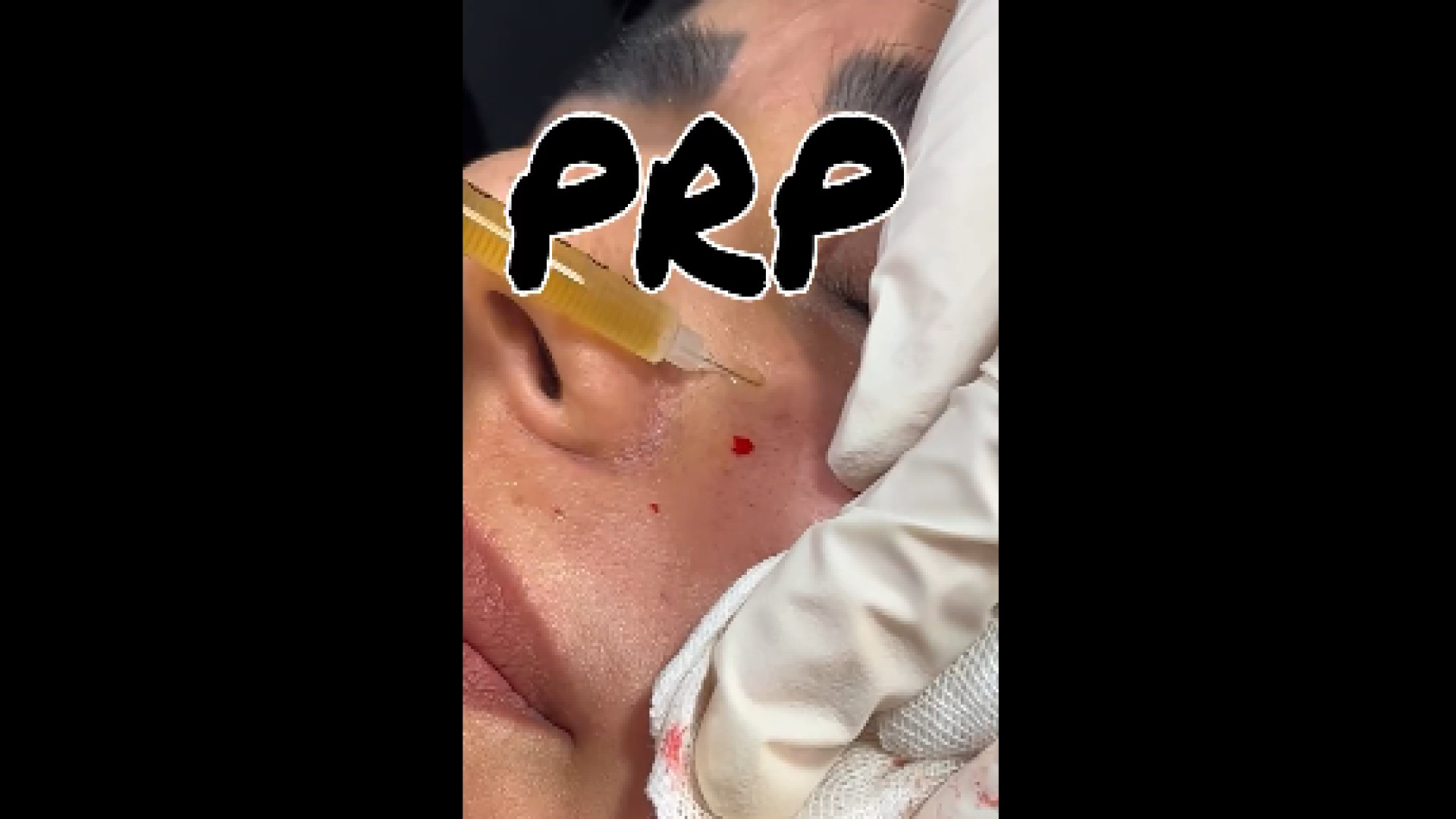 تزریق PRP دکتر صدیقه نائیجی | متخصص پوست و مو در قم