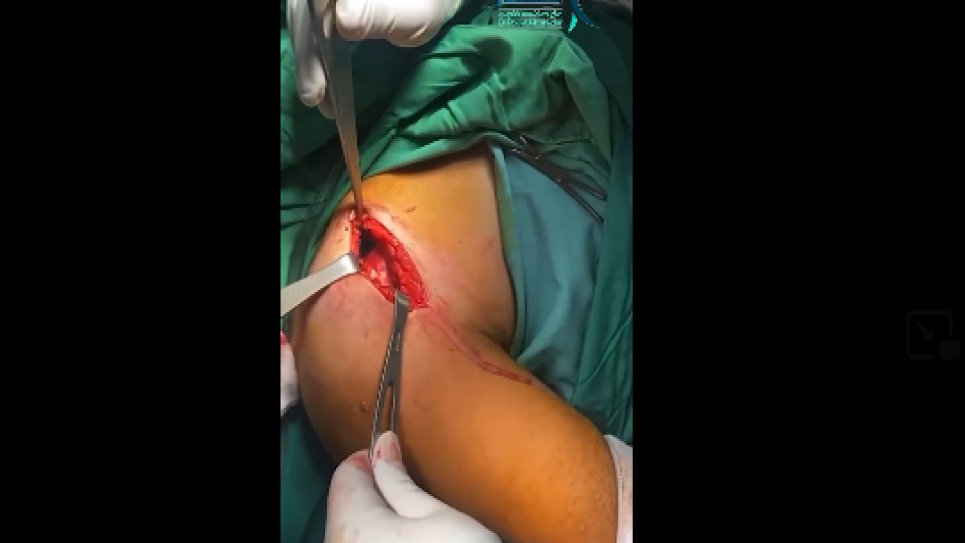 فیلم جراحی دررفتگی شانه لیزر فرکشنال