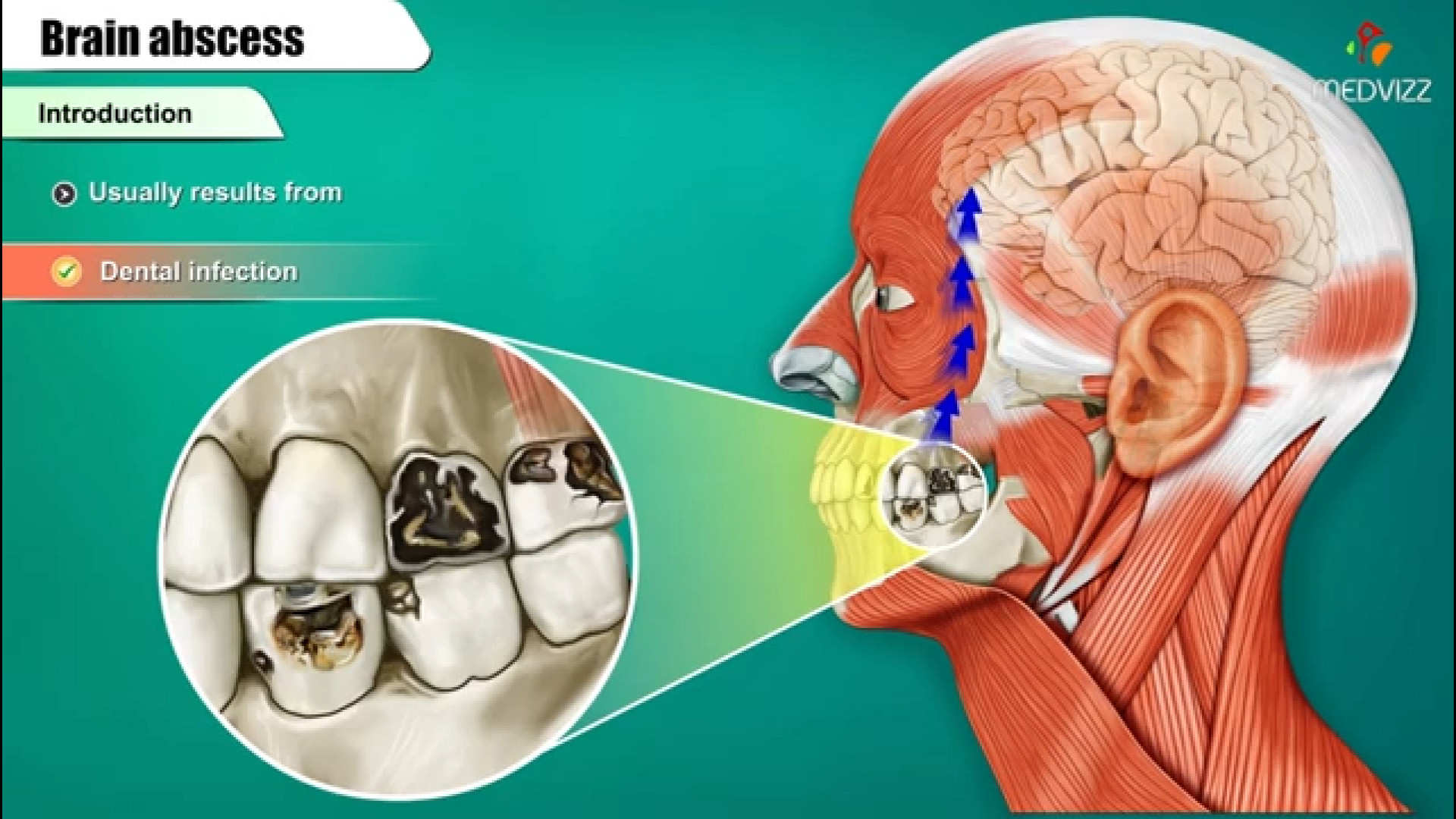 آبسه مغزی پاتولوژی اتیولوژی , پاتوژنز جراحی زیبایی پلک