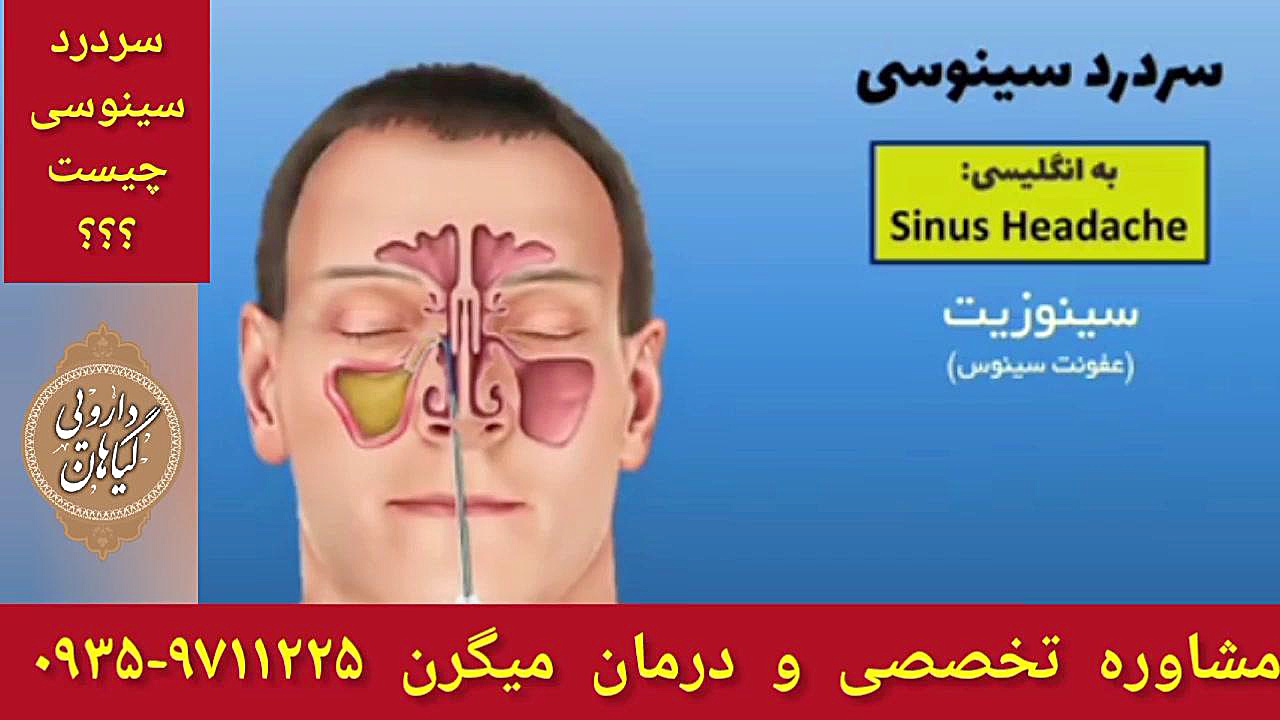 سینوزیت چیست درمان میگرن و سردرد عصبی ۰۹۳۵۹۷۱۱۲۲۵ کالا دیجیتال