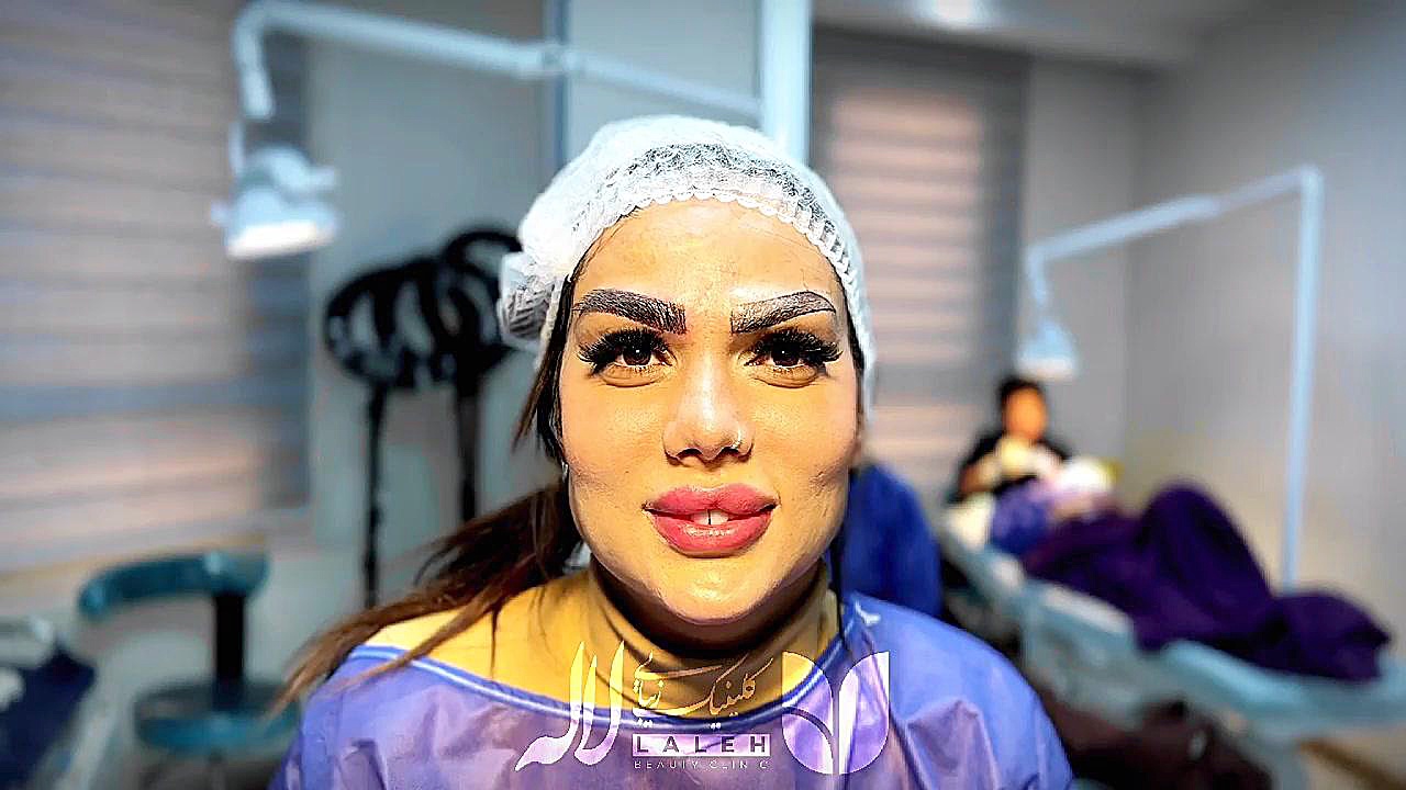 کاشت ابرو در کلینیک لاله میکروالکترود آرایه‌ای