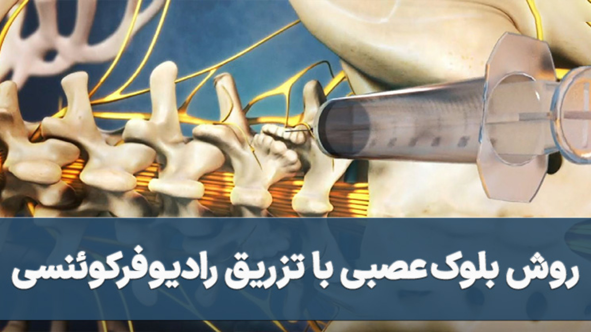 روش بلوک عصبی با تزریق رادیوفرکوئنسی پلاستیک لثه