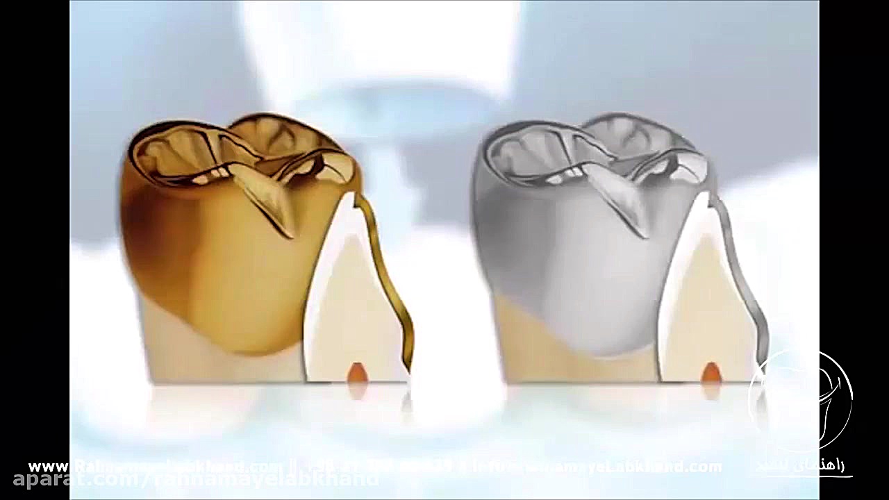 روکش دندان اصلاح فرم صورت