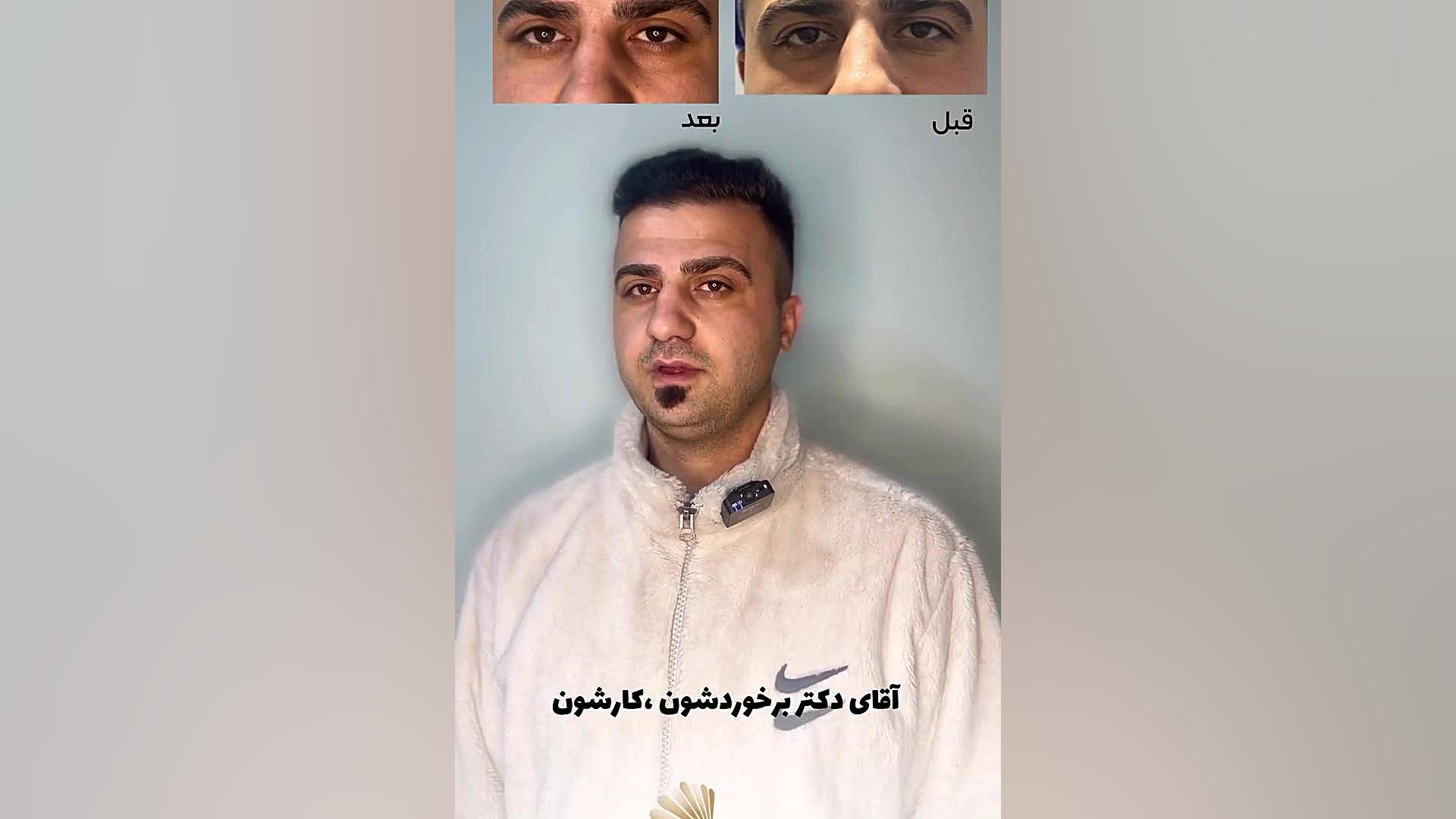 بنظرتون بلفاروپلاستی درد داره؟ لمینت