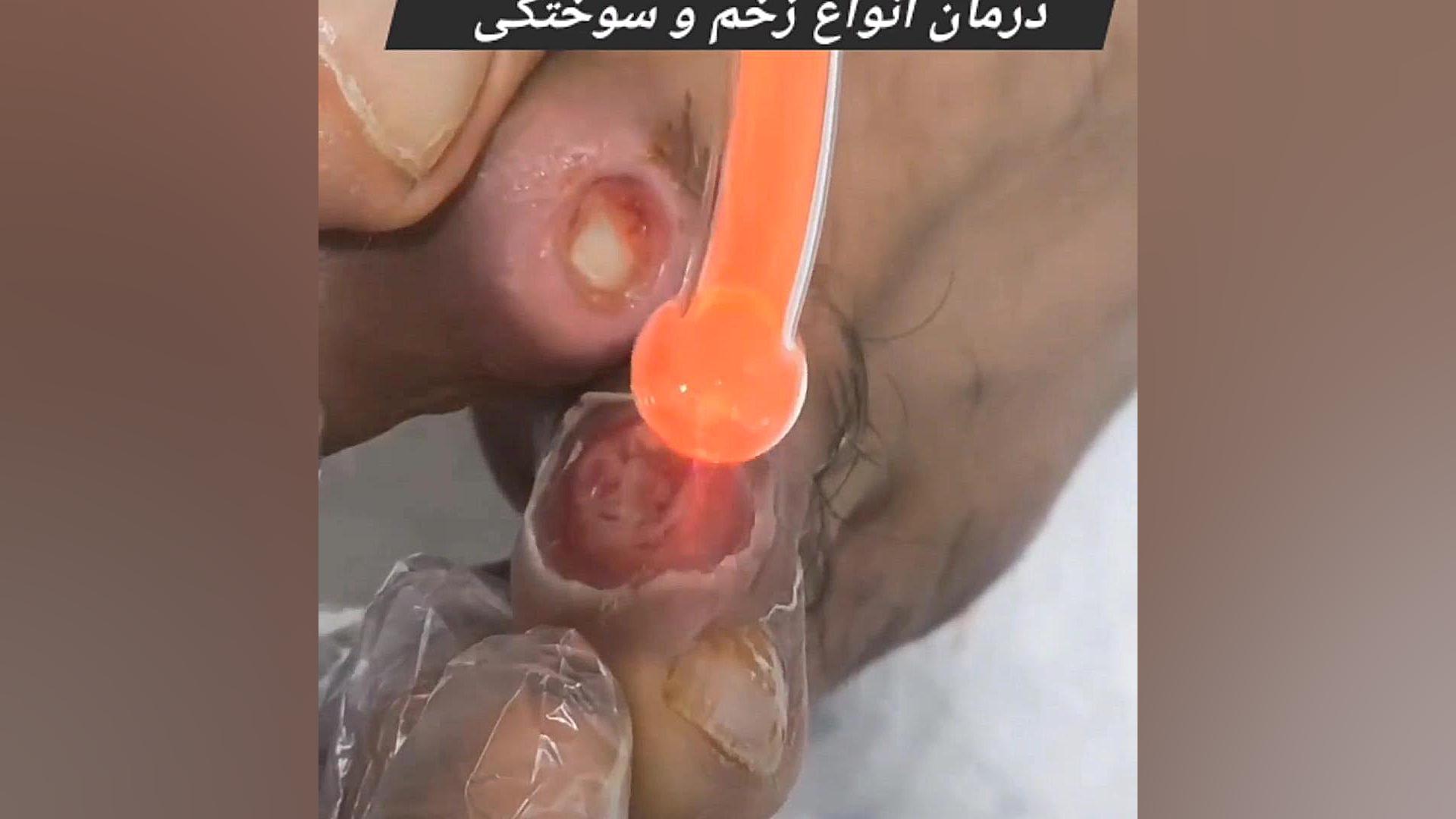 درمان زخم و سوختگی به روش پلاسماتراپی پاکسازی پوست