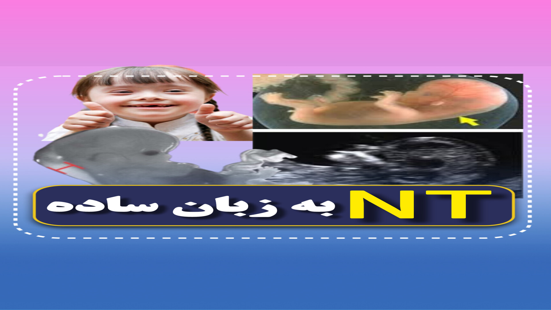 NT تو بارداری یعنی چی؟ ۰۲۱۲۲۹۱۱۳۷۰ (سونو مبنا) مرکز تصویربرداری دکتر مریم ابراهیمی، مبنا-تهران