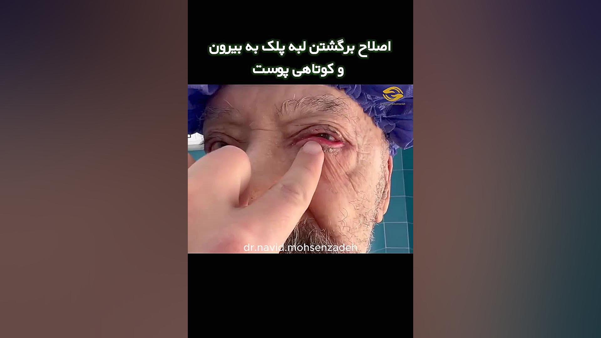 اصلاح برگشتن لبه پلک به بیرون لیپوساکشن