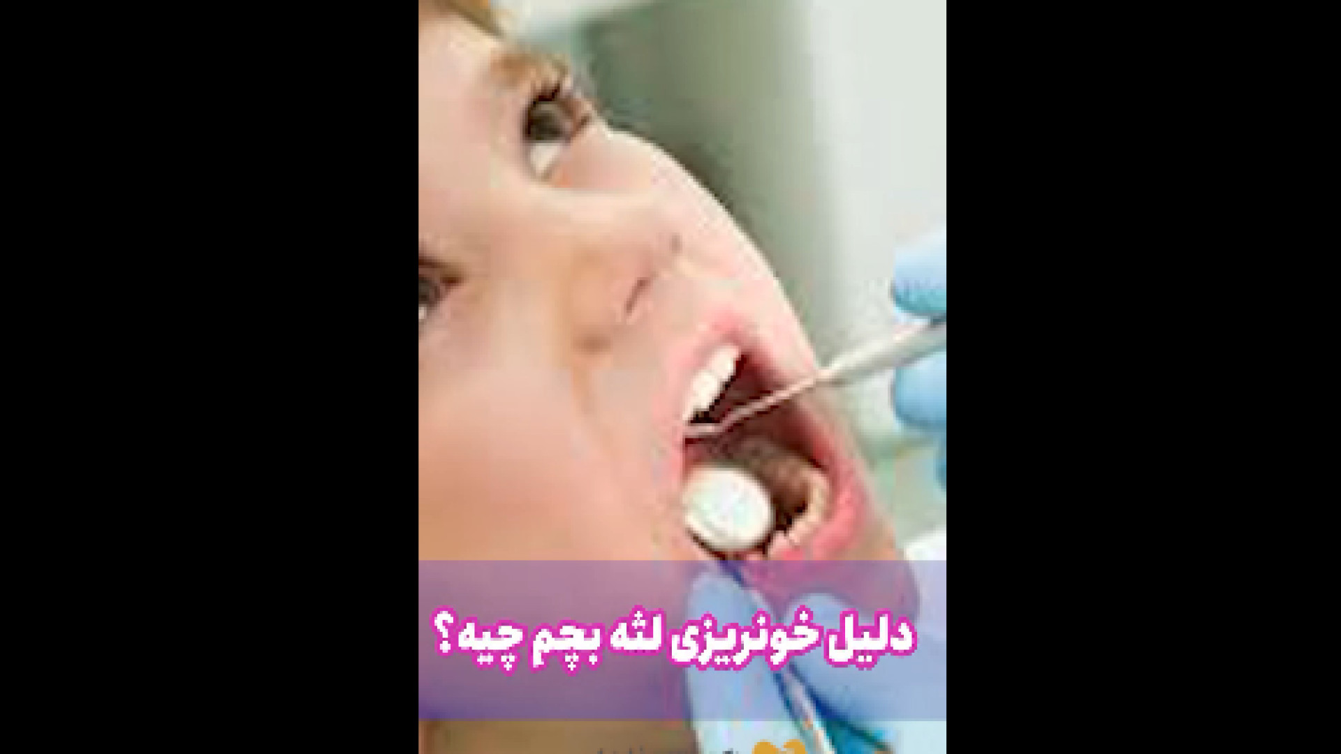 علت خونریزی لثه بچه ها دکتر آزاده فاضل _ دندان پزشک کودکان