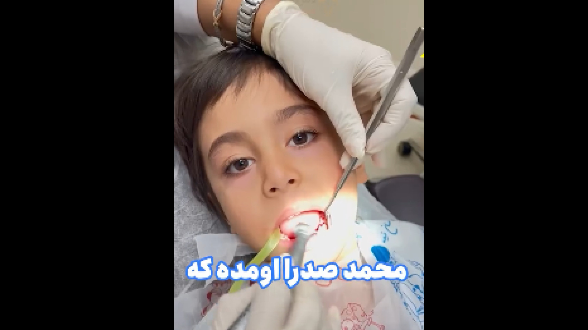 پالپوتومی دندان کودکان دکتر آزاده فاضل _ دندان پزشک کودکان