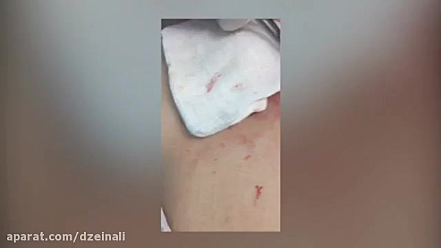 جراحی کیست دکتر فرحناز زینعلی - متخصص پوست، مو، زیبایی زنجان