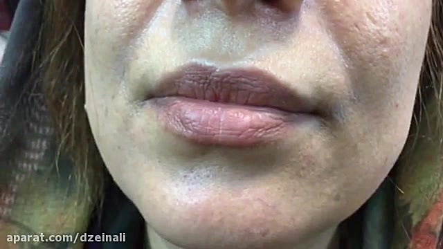 پر کردن و جوانسازی خط خنده دکتر فرحناز زینعلی - متخصص پوست، مو، زیبایی زنجان