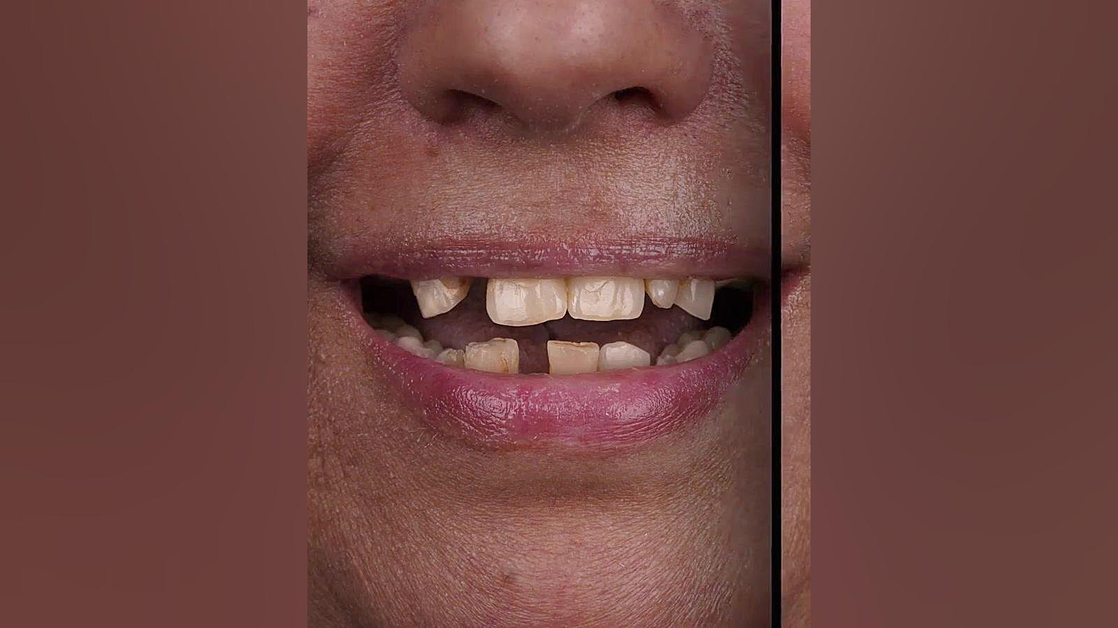 اجرای ایمپلنت دندان فوری به همراه روکش لمینت در کلینیک دکتر گیاهپور دکتر اللهیار گیاهپور