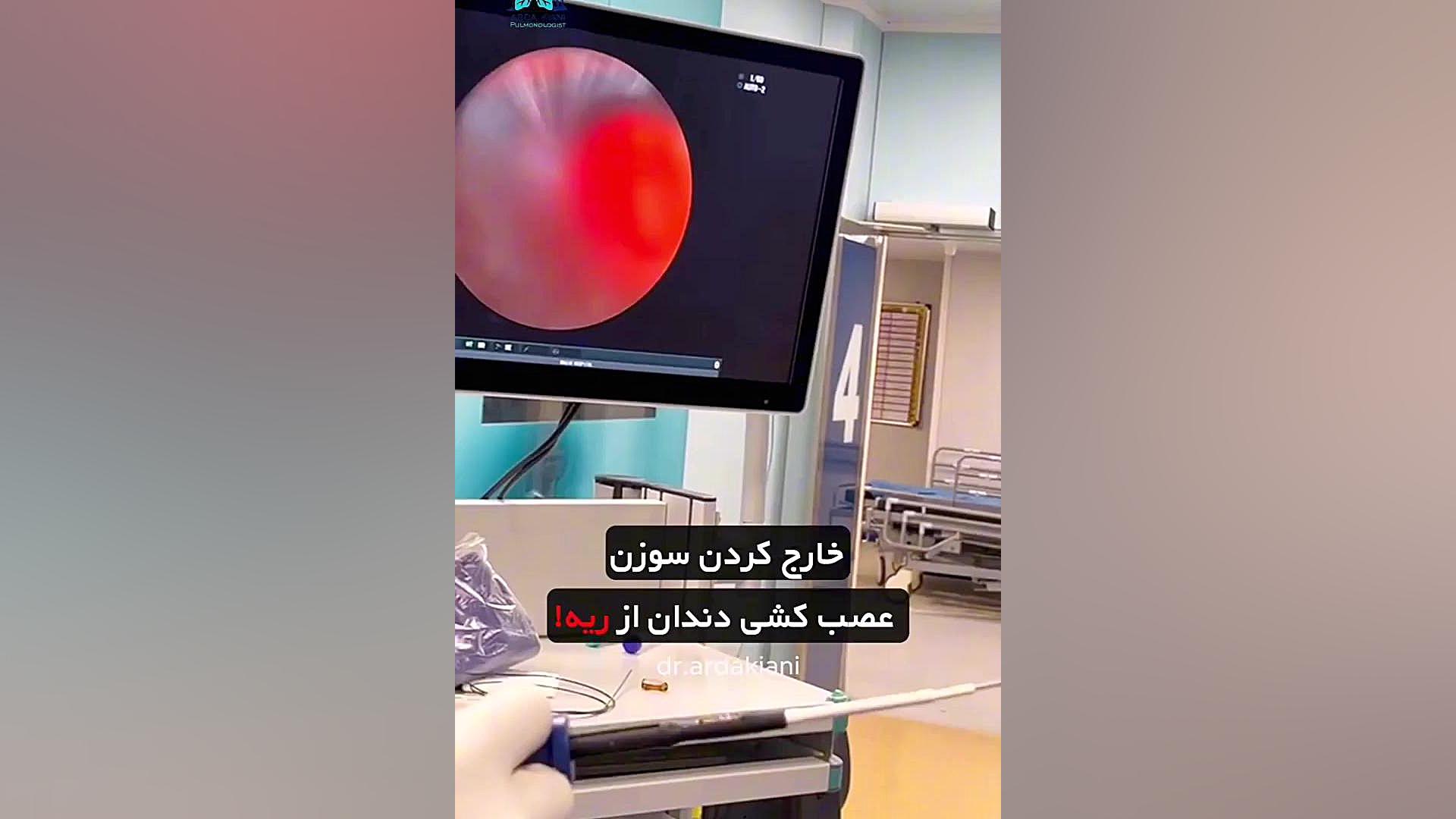 خارج کردن سوزن عصب کشی دندان از ریه دکتر اردا کیانی