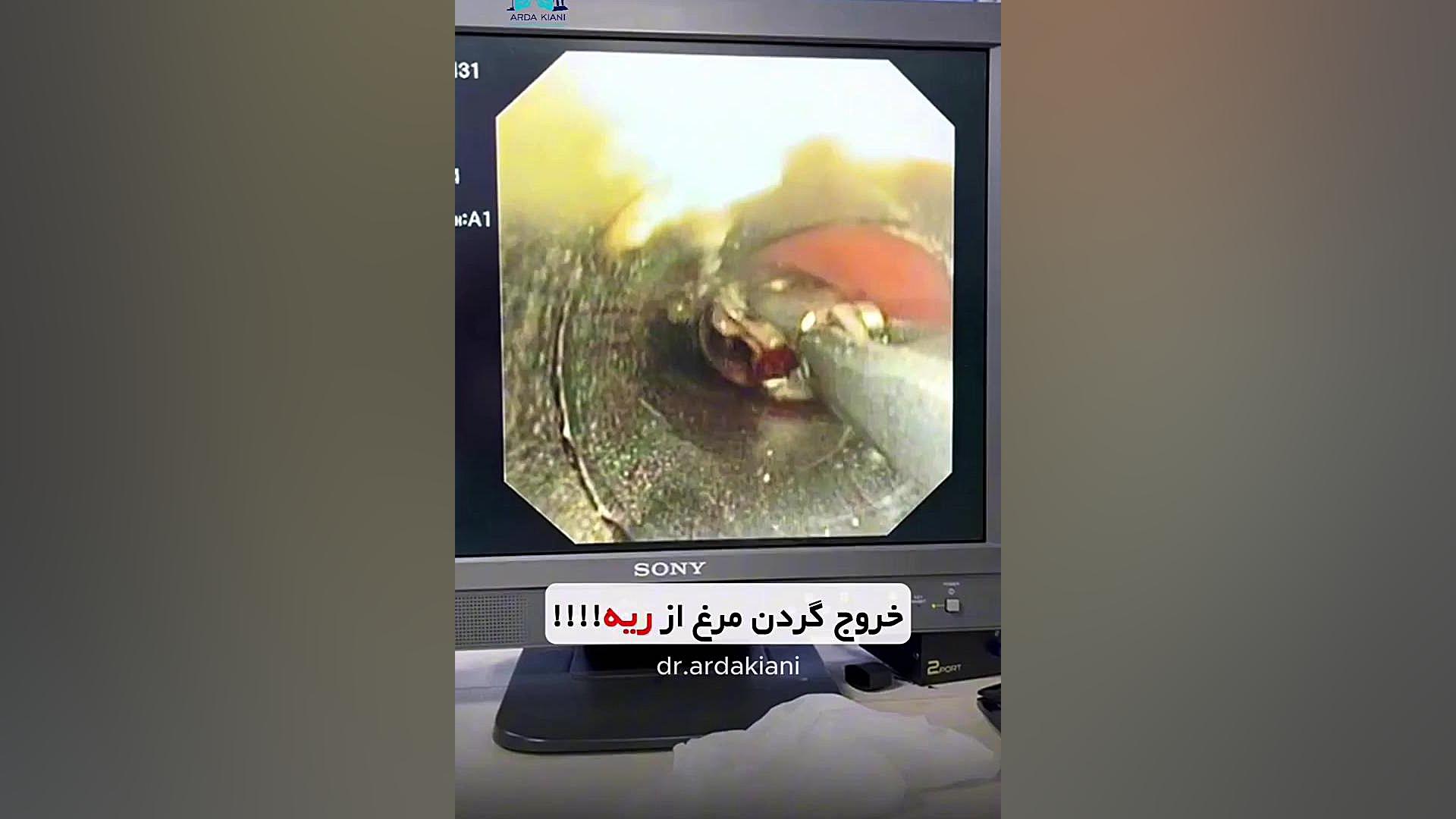 خروج گردن مرغ از ریه!! دکتر اردا کیانی