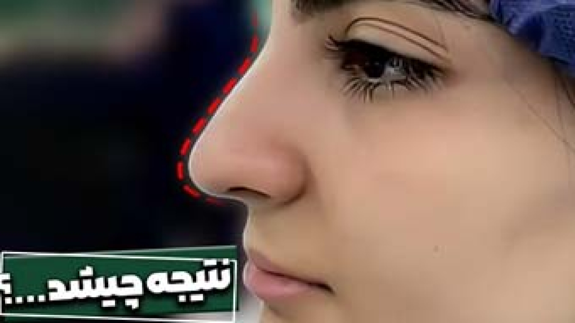 قبل و بعد از عمل بینی | دکتر علی باقری حق دکتر علی باقری حق