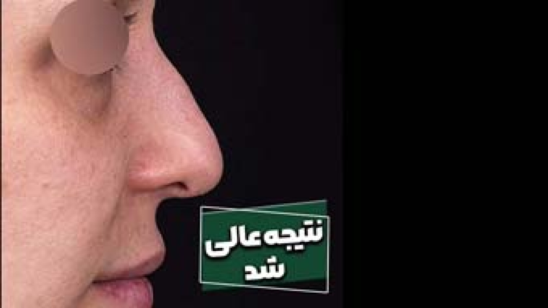 رفع ایرادات بینی و در نهایت یک بینی متناسب با صورت | دکتر علی باقری حق دکتر علی باقری حق