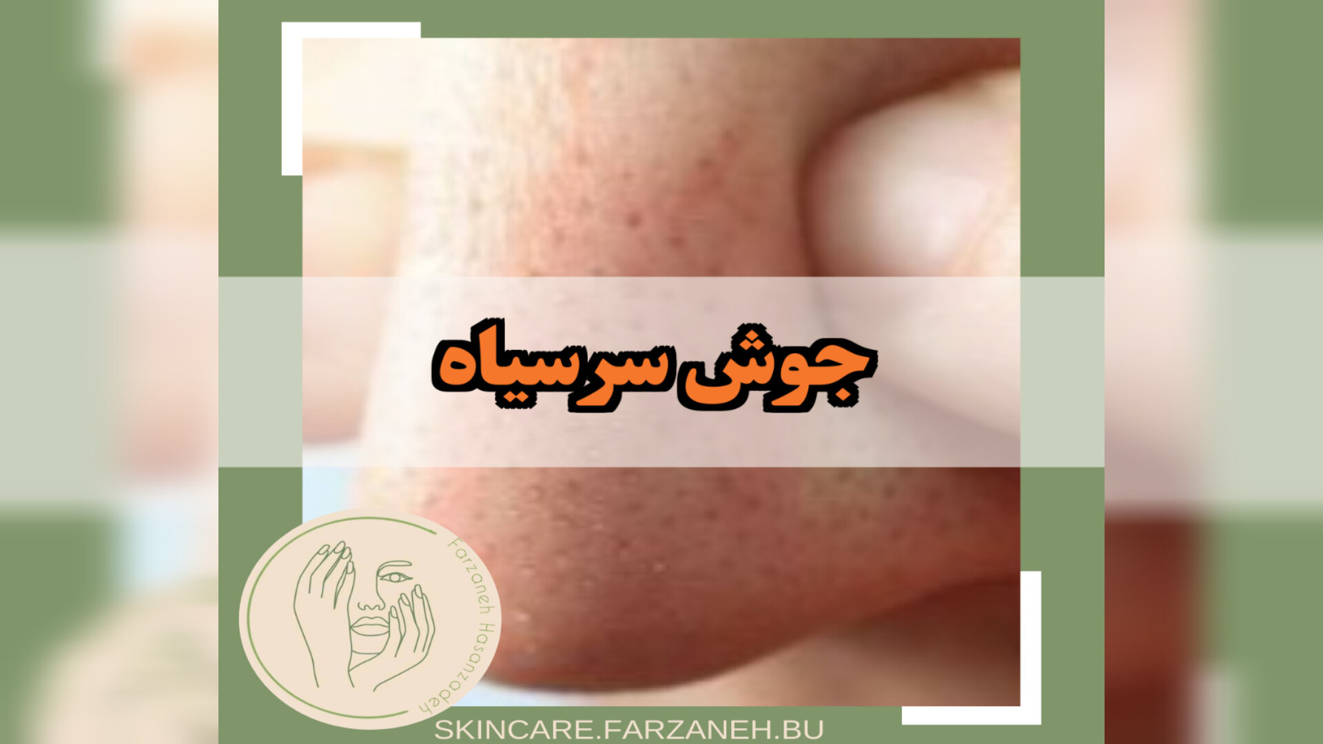 جوش های سر سیاه بررسی لک صورت