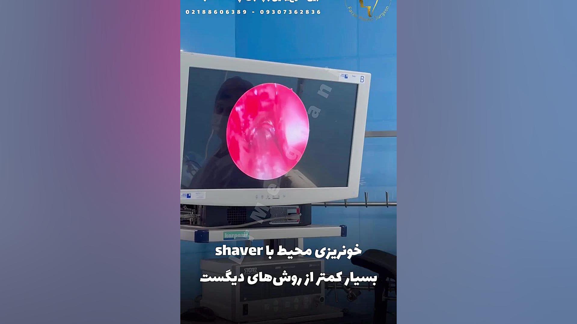 جراحی آندوسکوپی سینوس تری‌متازیدین