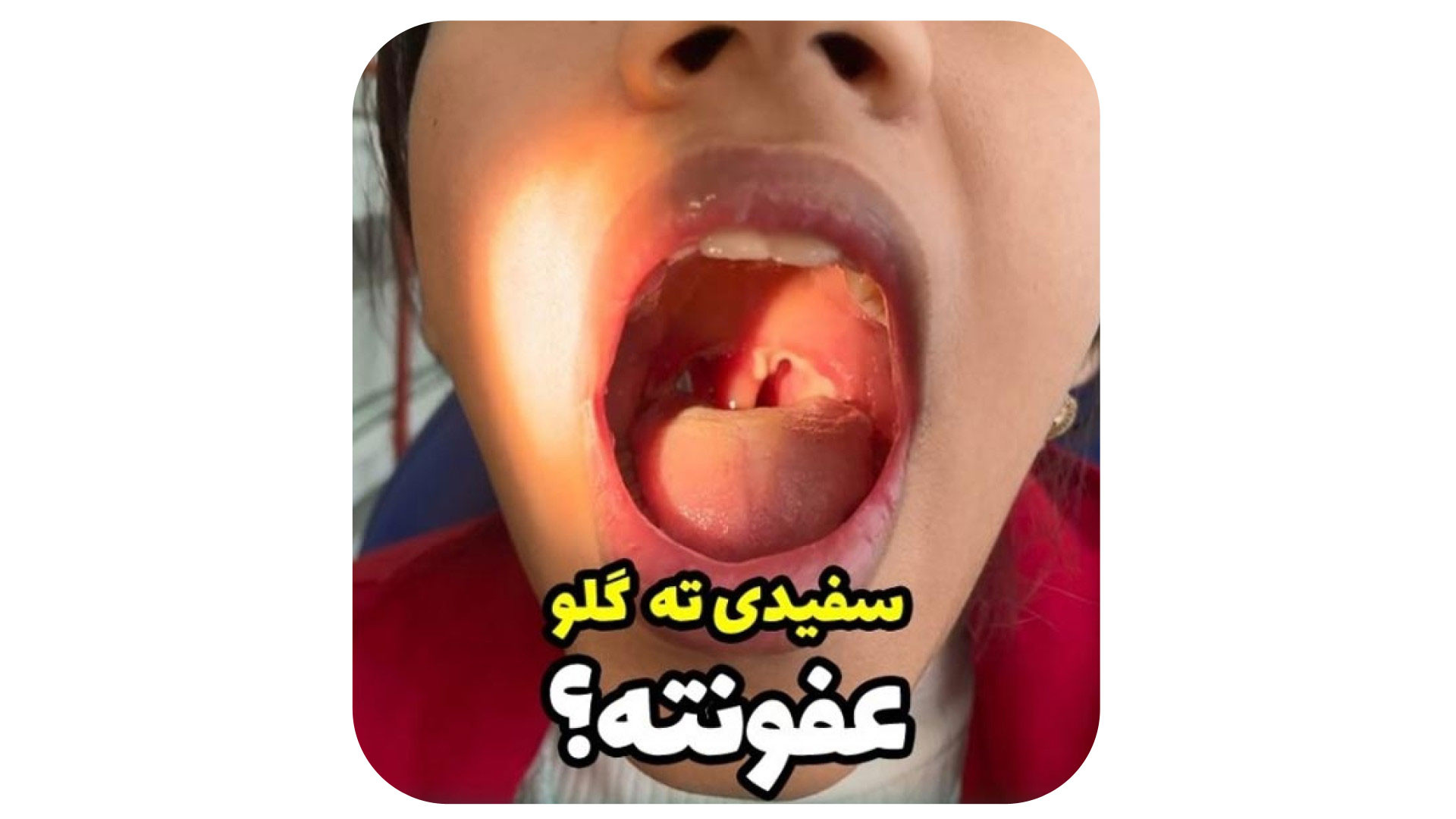 عفونت گلو و لوزه دکتر حامد محمدی قهاری