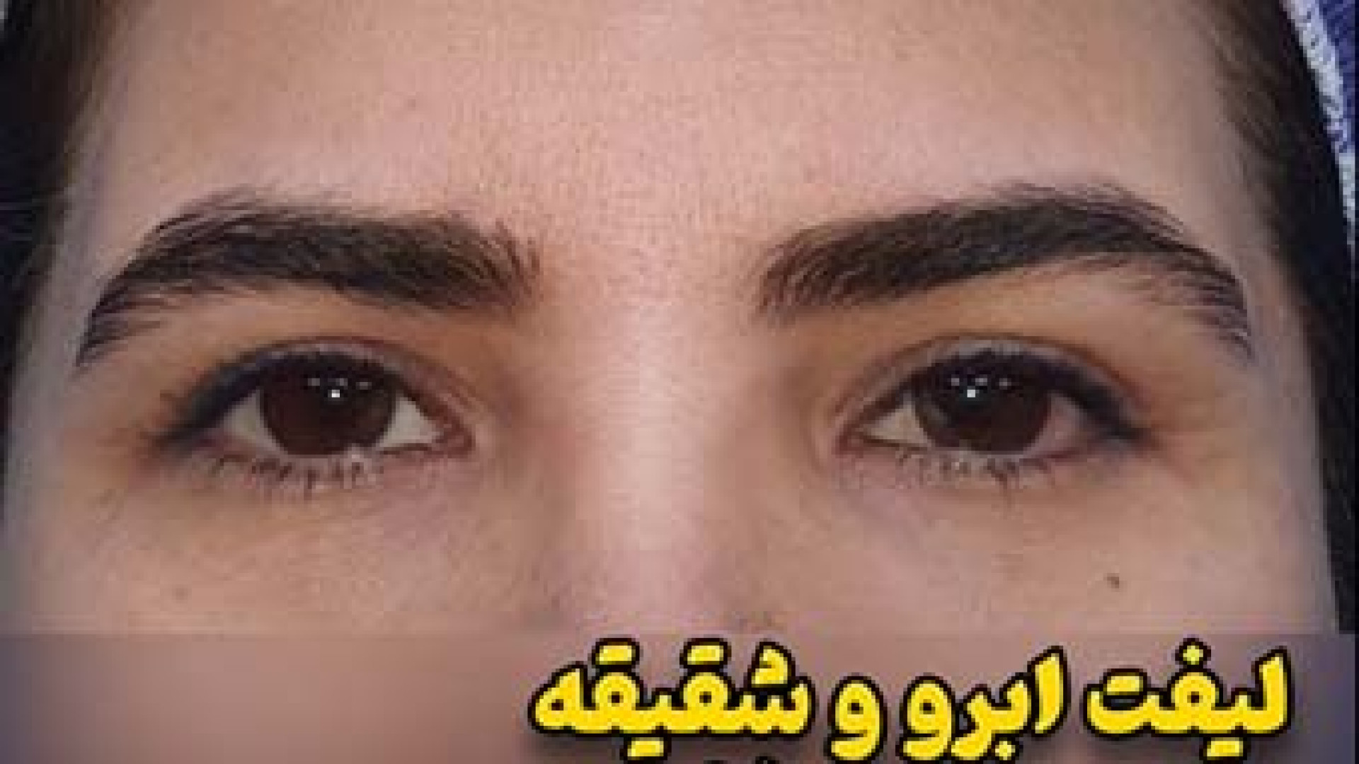 لیفت ابرو و پیشانی به روش آندوسکوپی | دکتر مجتبی سهرابپور میکروسفالی
